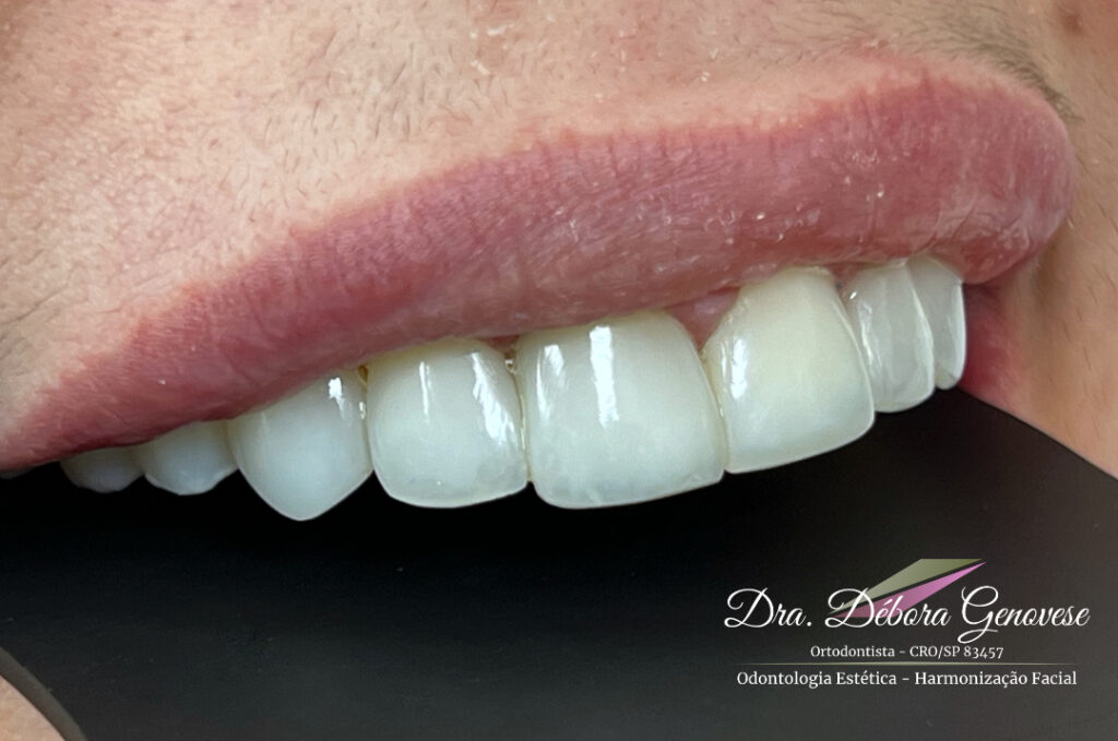 Lente Dental Estratificada