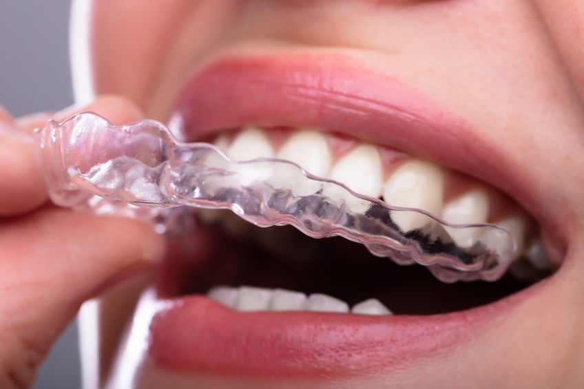 Close-up Of A Woman's Hand Putting Transparent Aligner In Teeth