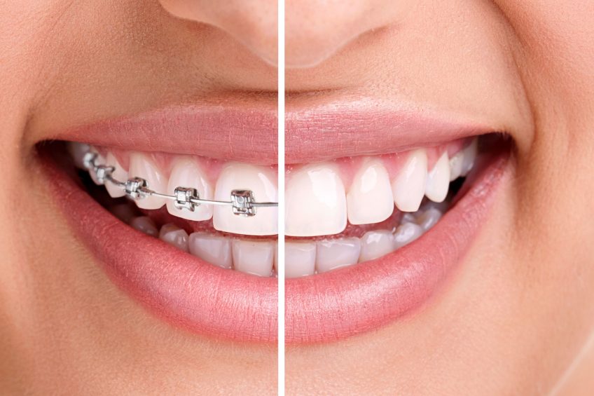 woman teeth and smile. Close up,half with braces